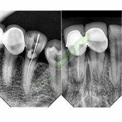 Woodpecker i-Sensor H1 Dijital X-Ray RVG Görüntüleme Sistemi