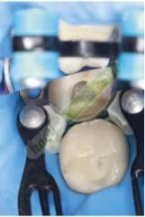 Tecci Promotion Sectional Matrix Kit 2